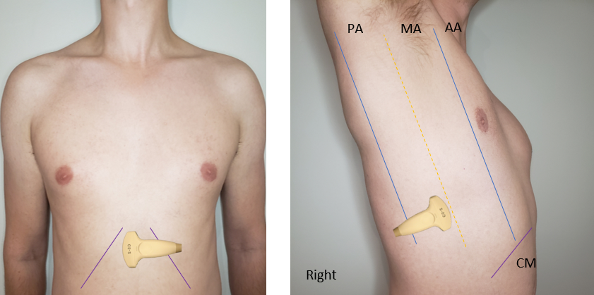 Ivc Ultrasound Toronto Internal Medicine Pocus